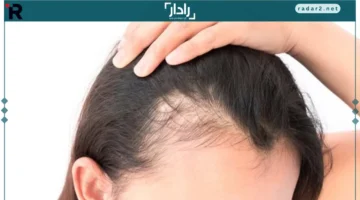 خسارة الشعر.. تعرف على أبرز الأسباب وأساليب العلاج المبتكرة لانحسار خط الشعر